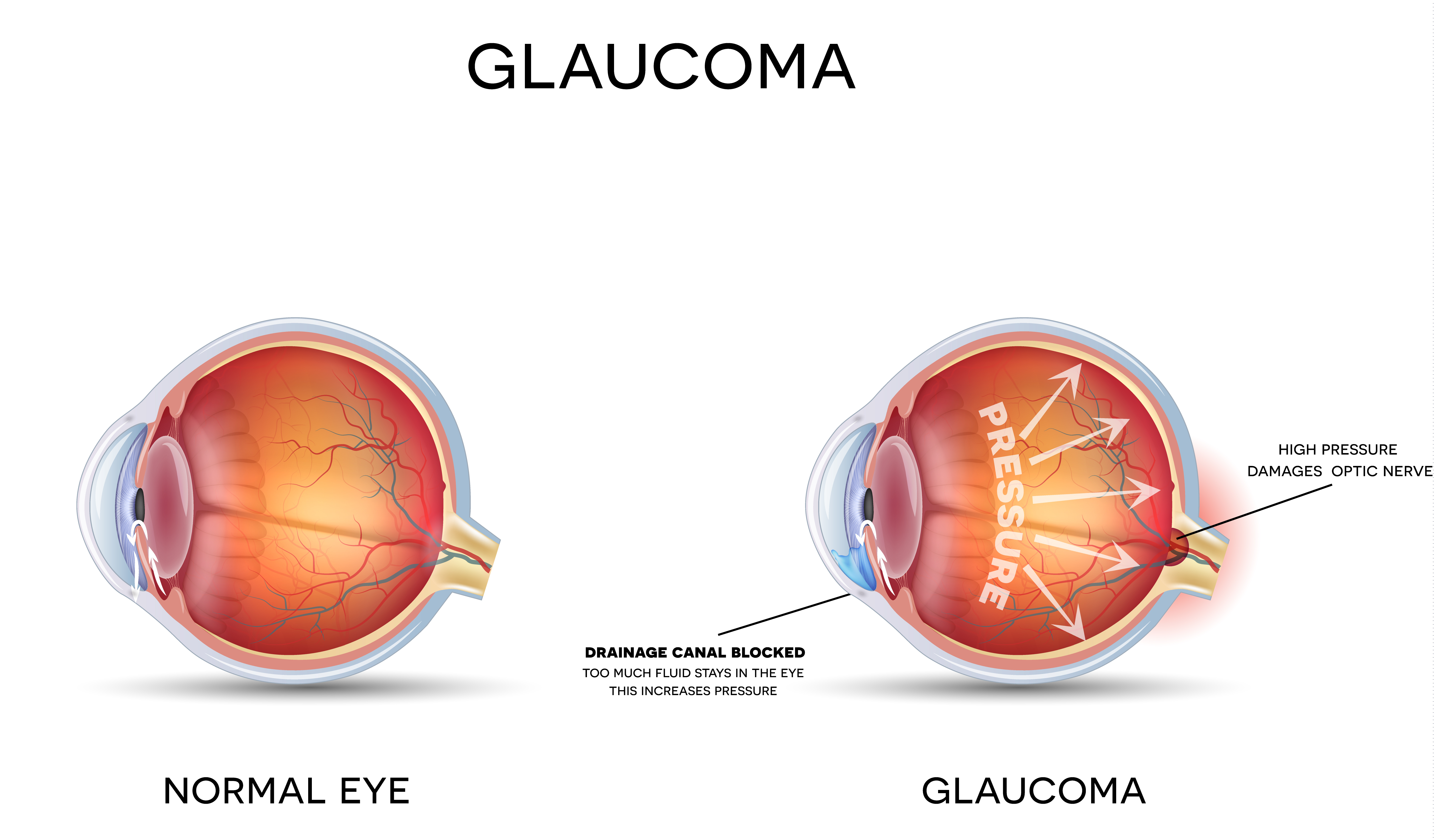 Gloucoma